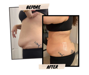 Tummy Tuck Tape Method – SUPPORT TAPE